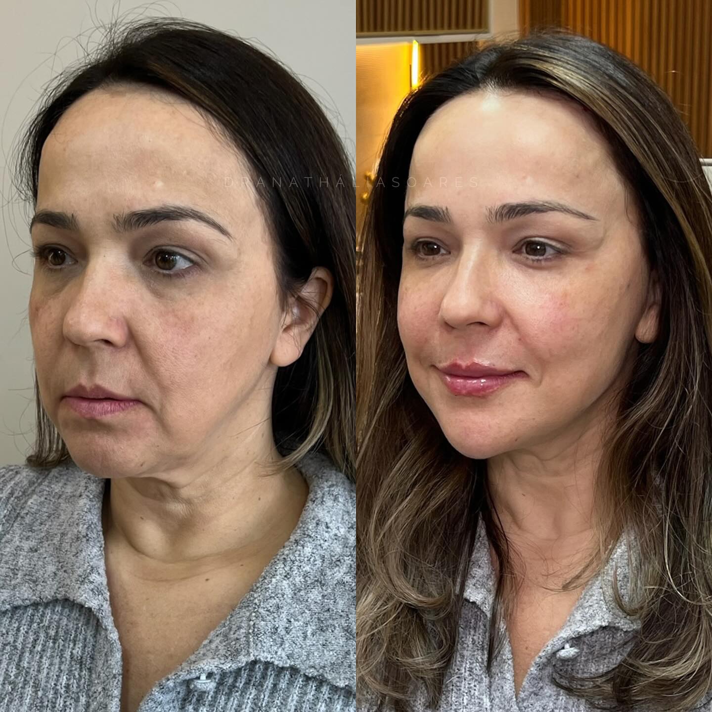 Antes e depois de harmonização facial — paciente 2