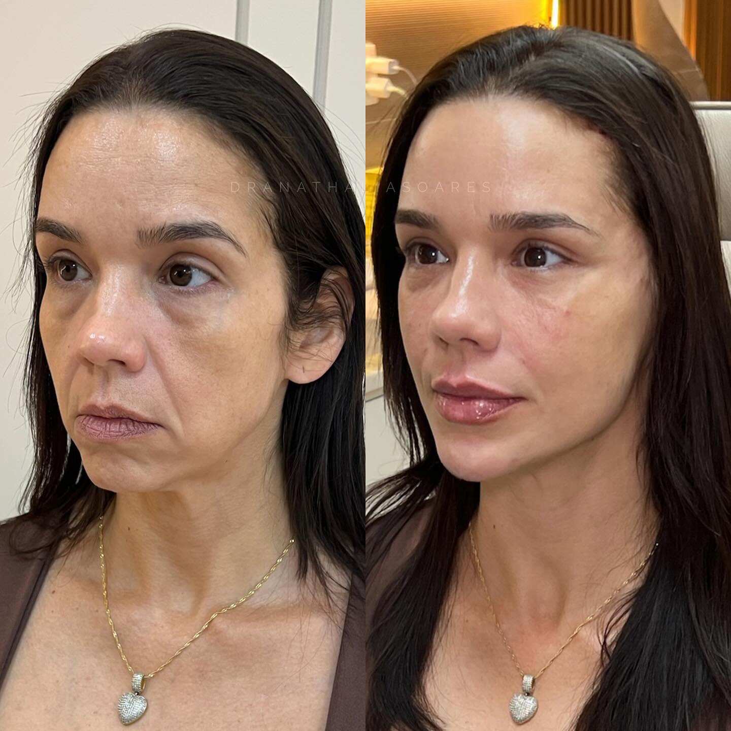 Antes e depois de harmonização facial — paciente 3