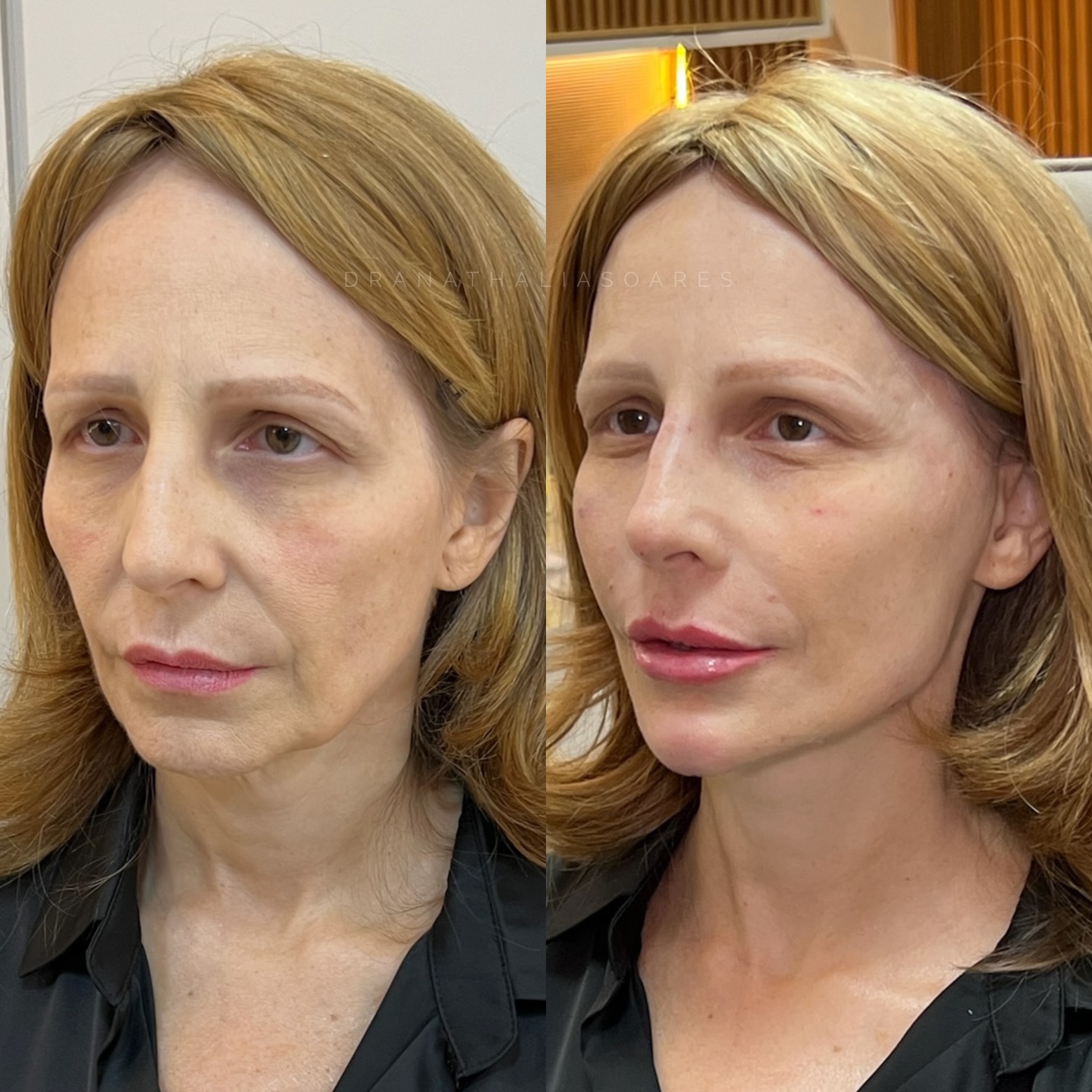 Antes e depois de harmonização facial — paciente 1
